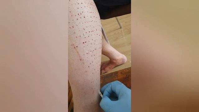 Хиджама на боль в локтях  на ногах  hijama  cupping  الحجامة    çukurluğu