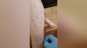 Хиджама на боль в локтях на ногах hijama cupping الحجامة çukurluğu