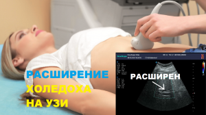 Как выглядит РАСШИРЕННЫЙ ХОЛЕДОХ на УЗИ?