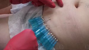 Подтяжка кожи живота нитями