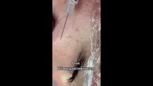 Просянка и Жировики. Ответ Косметолога - Как Правильно Избавиться от Прыщей (2021)