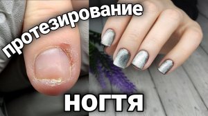 Протезирование ногтя после травмы
