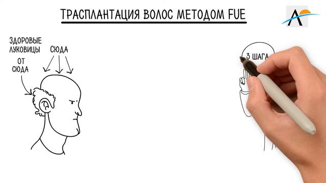 Аратравел и доктор Серкан Айгин объясняют, как и почему работает трансплантация методом FUE смотреть онлайн