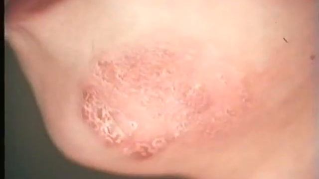 Трихофития - грибок волос, кожи, ногтей © Trichophytosis - a fungus of hair, skin, nails смотреть онлайн