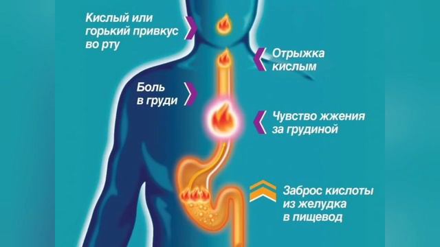 Изжога! Какая причина изжоги и что делать? смотреть онлайн