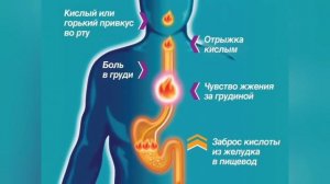 Изжога! Какая причина изжоги и что делать?