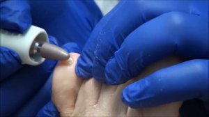 What are Fungal Nails? Talking Toenails with Dr Nail Nipper - Throwback Thursday