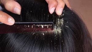 Wow!! Huge Dandruff Flakes Removal!! Itchy Psoriasis Scalp Dandruff Scratching on Sister Hair