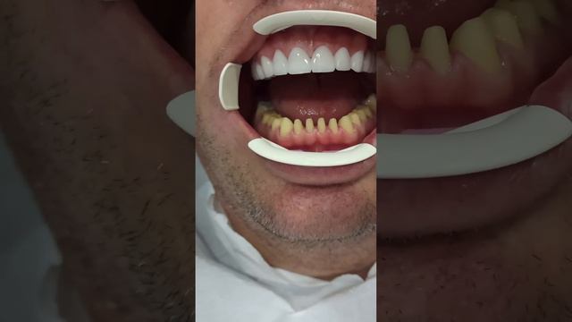 Before and After Zirconium Crowns