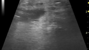 Сиалолитиаз подчелюсной слюнной железы