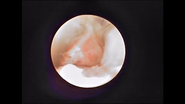 Воспалительный полип среднего уха смотреть онлайн