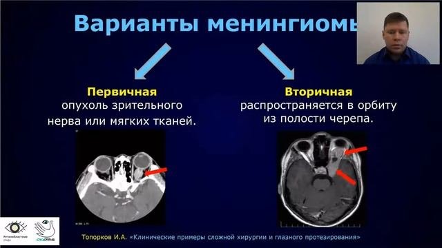 Клинические примеры сложной хирургии и глазного протезирования: разбор и обсуждение тактики». ГП-20
