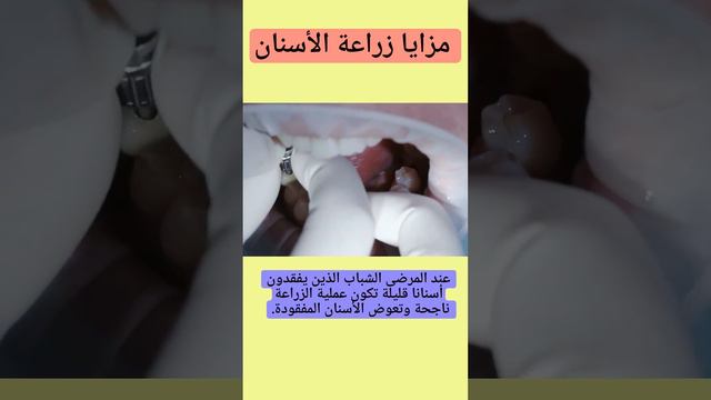 خمس مزايا  لزراعة الأسنان وخمس مخاطر لعملية زراعة الأسنان دليلك لزراعة الاسنان في الاردن