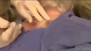 Жировик на спине #5