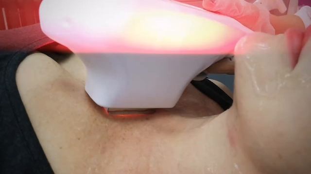 Омоложение декольте, удаление возрастной пигментации смотреть онлайн