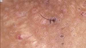 Blackheads extraction | ingrown ???