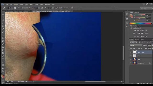 Fixing a BOTCHED surgery смотреть онлайн