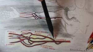 обнажение и перевязка плечевой артерии