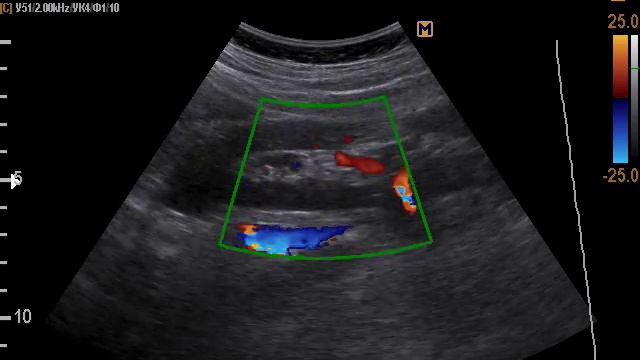 Удвоение сосудов почки (17-2-17) смотреть онлайн
