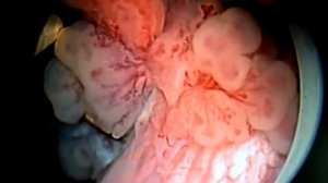 ТУР биопсия мочевого пузыря