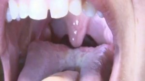 Girl gagging (Huge uvula)