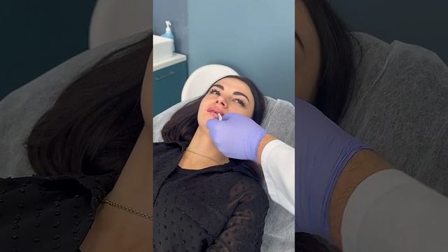 Увеличение губ филлерами на основе гиалуроновой кислоты. смотреть онлайн