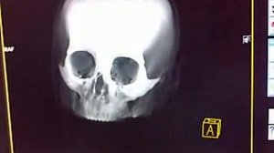 Череп КТ часть 5 skull CT part 5