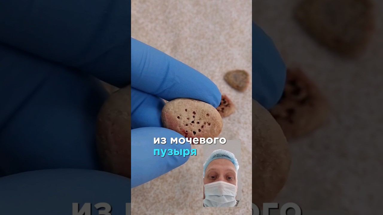 В мочевом пузыре выросли камни #уролог #спб #здоровье #технологии #камень #жизнь #такаяработа