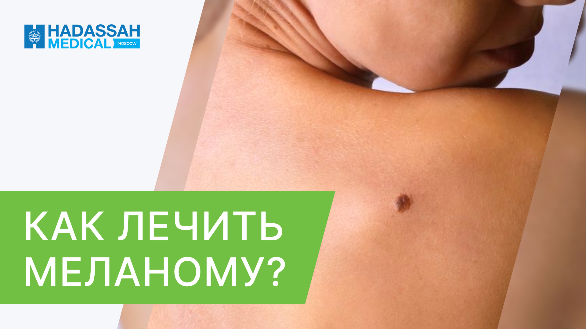 ? Какие современные методы лечения меланомы кожи применяются в Hadassah? Лечение меланомы кожи. 18+