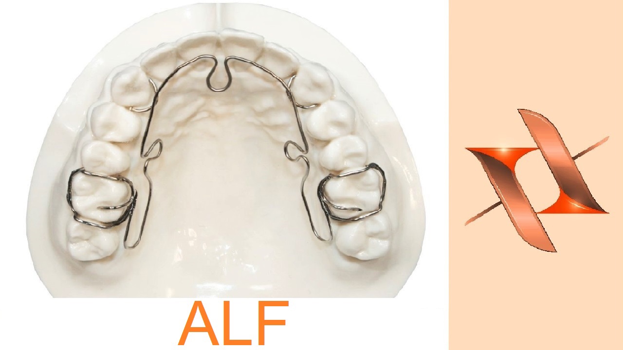 Аппарат лёгких сил ALF. Ортодонтия.