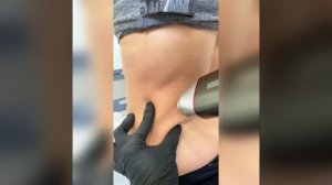 Игольчатый РФ-ЛИФТИНГ для тела.