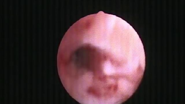 Трёхлетний приём Ярины в 22 года. Эндометрий. смотреть онлайн