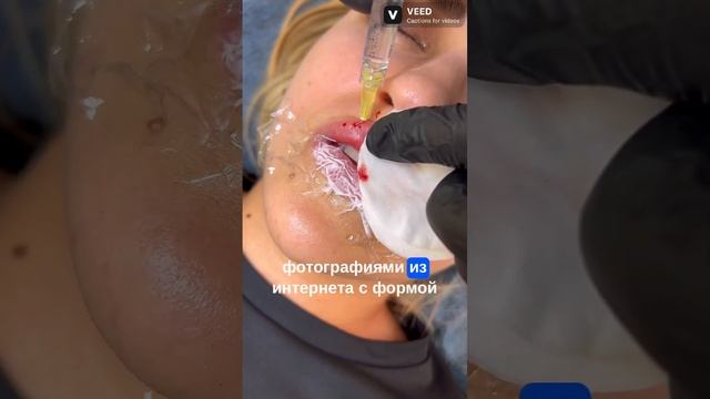Контурная пластика губ: от начала и до конца. Секреты выбора иглы.