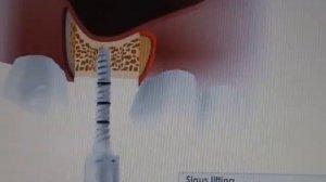 Sinus lift video :using MIS-Implants Bone compression kit