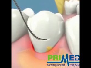 ЛЕЧЕНИЕ ГИНГИВИТА В СТОМАТОЛОГИЧЕСКОМ ЦЕНТРЕ ГОРОДА. СТОМАТОЛОГИЯ СПБ PRIMED.