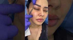 Результат на 7-й день после блефаропластики по типу Сангапури. Все вместе посмотрим результат ?