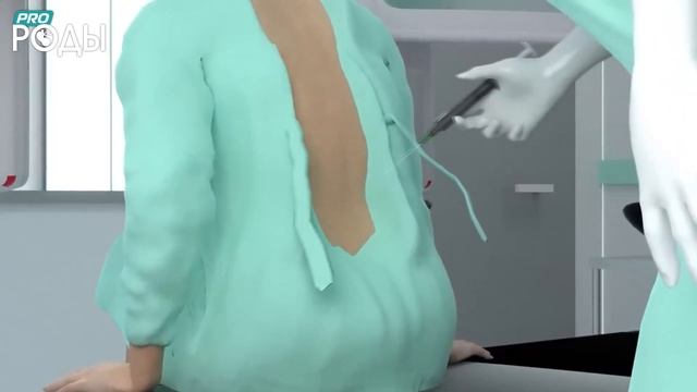 Кесарево сечение 3D анимация