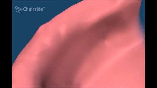 Что делать что бы лучше держались съемные протезы Хирургическая подготовка Стоматология смотреть онлайн