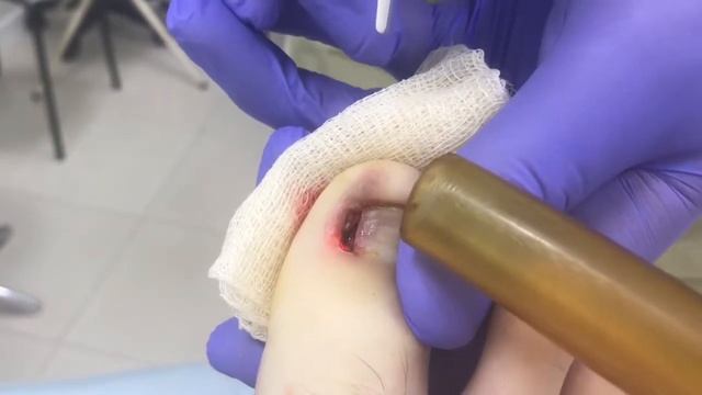 вросший ноготь удаление смотреть онлайн