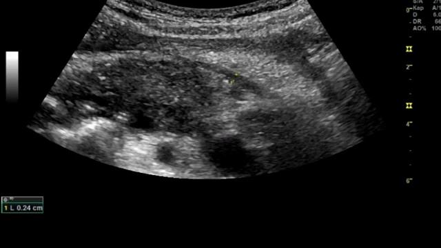 Тромбоз воротной и селезеночной вен на фоне острого панкреатита смотреть онлайн