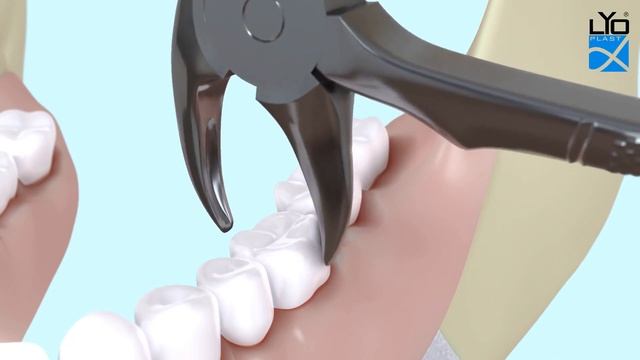 Консервация альвеолы после удаления корня зуба или сильно разрушенного зуба смотреть онлайн