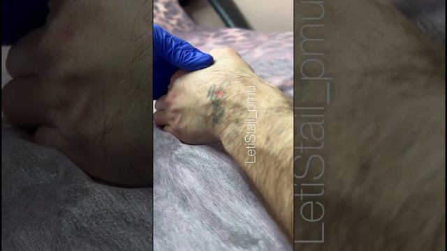 Удаление татуировок лазером! Самый эффективный способ удаления! #удалениетату смотреть онлайн