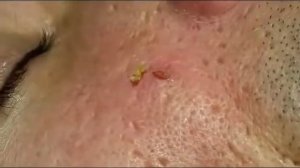 №1 Выдавливание прыщей на лице ¦ Squeezing pimples on the face