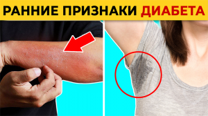 6 ранних симптомов диабета! / Как понять, что у вас диабет?