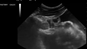 8 Гидроторакс средостение