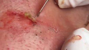 Blackheads extrations Bigblackheads Bigblackheadsonthenose asmr whiteheads face #013