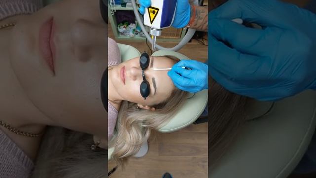 ЛАЗЕРНОЕ удаление татуажа