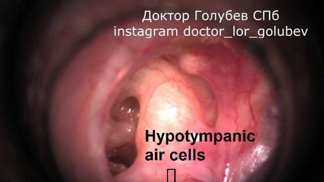 хронический гнойный средний отит смотреть онлайн