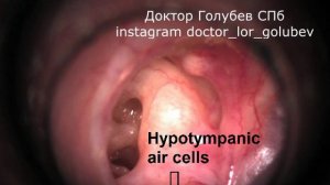 хронический гнойный средний отит