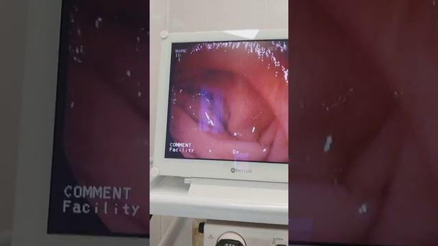 Гастроскопия ультра тонкий гастроскоп смотреть онлайн